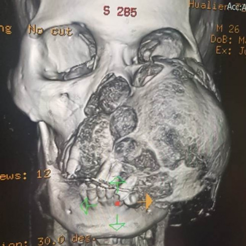 大破壞後的重建，要維持麥可左眼、鼻部呼吸、口腔功能和外觀，整形暨重建外科團隊為麥可進行眼眶顴骨複合區結構重建