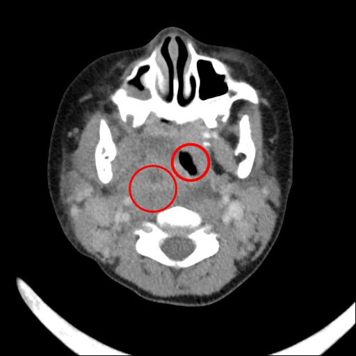 左紅圈處是膿瘍位置，右紅圈處是氣管；正常情況下氣管應位於中央，但圖中情形則是咽喉部被膿瘍壓迫至對側。