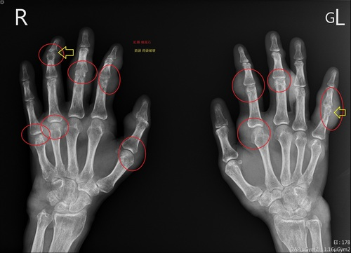 痛風患者手部X光片，紅圈為痛風石，黃色箭頭為遭破壞骨頭