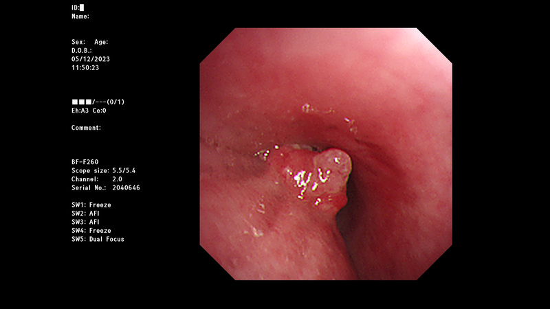 sss1放化療前支氣管鏡檢 左側主支氣管腫瘤侵犯