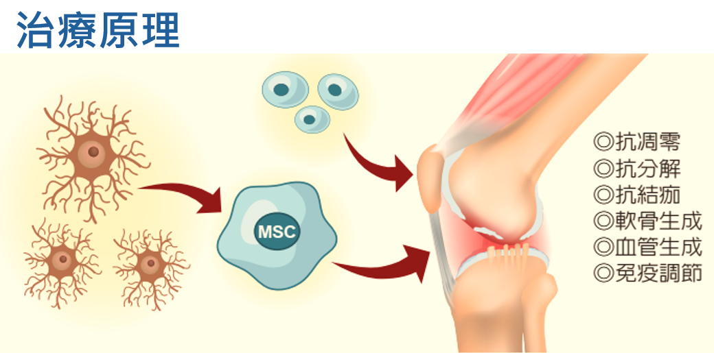 自體骨髓間質幹細胞：退化型膝關節炎治療的新選擇