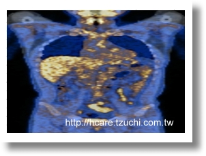 PET/CT融合冠狀影像 