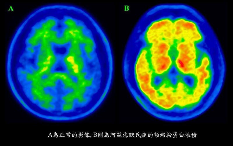 Florbetaben試劑臺灣臨床首用　非典型阿茲海默症無所遁形