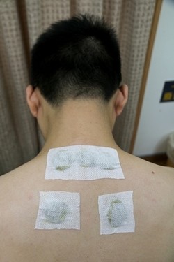 老祖宗夏季養生三伏貼　改善虛寒體質、鼻子過敏