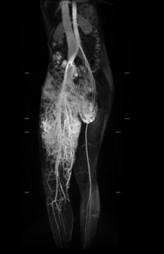 小班克右腿的動脈與靜脈是沒有經過微血管就直接相接的「動靜脈畸形」，兩腿間的動靜脈血管畸形腫瘤已成為拳頭大小，垂掛在兩腿間