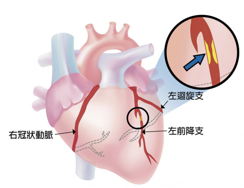冠狀動脈粥狀血管硬化，當冠狀動脈的血管壁裡面有不好的油(黃色處)堆積，而造成血管阻塞時，血管的血流量就會變小