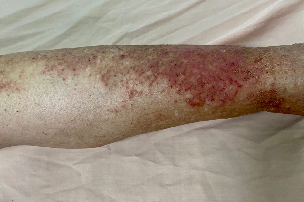 乾燥性皮膚炎臨床上常可見到皮膚乾燥伴隨細小脫屑，比較嚴重時會有皮膚乾裂甚至紅腫發炎。