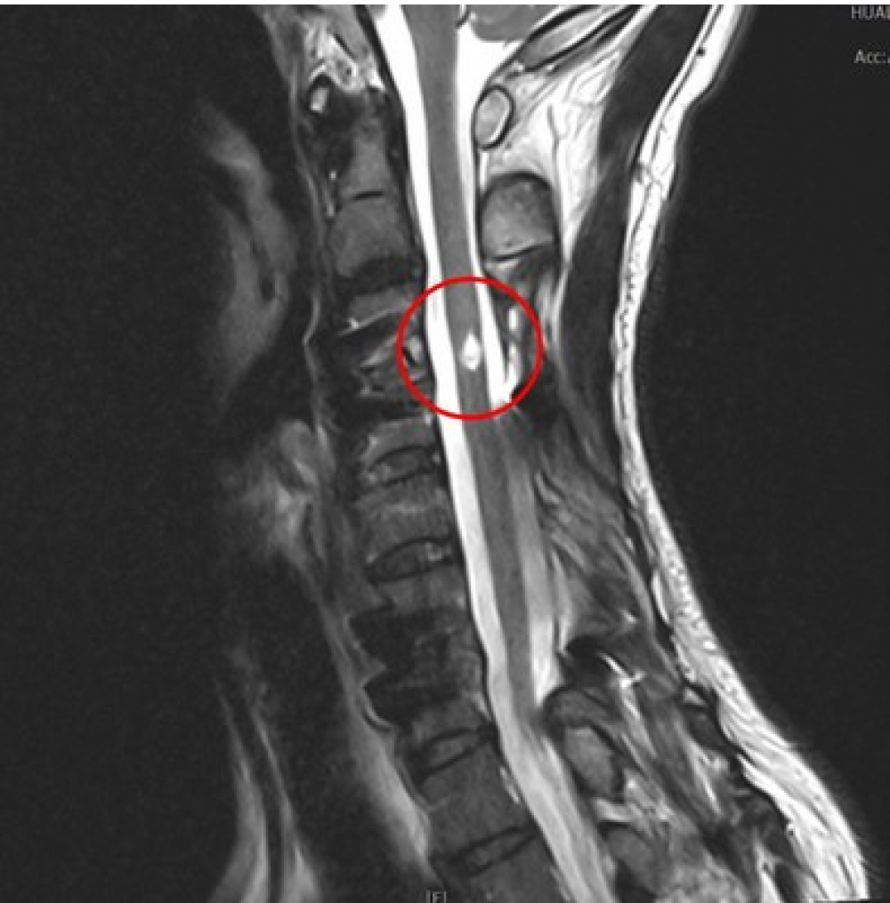 晶片刺激治療　脊損傷友找回下肢行動力