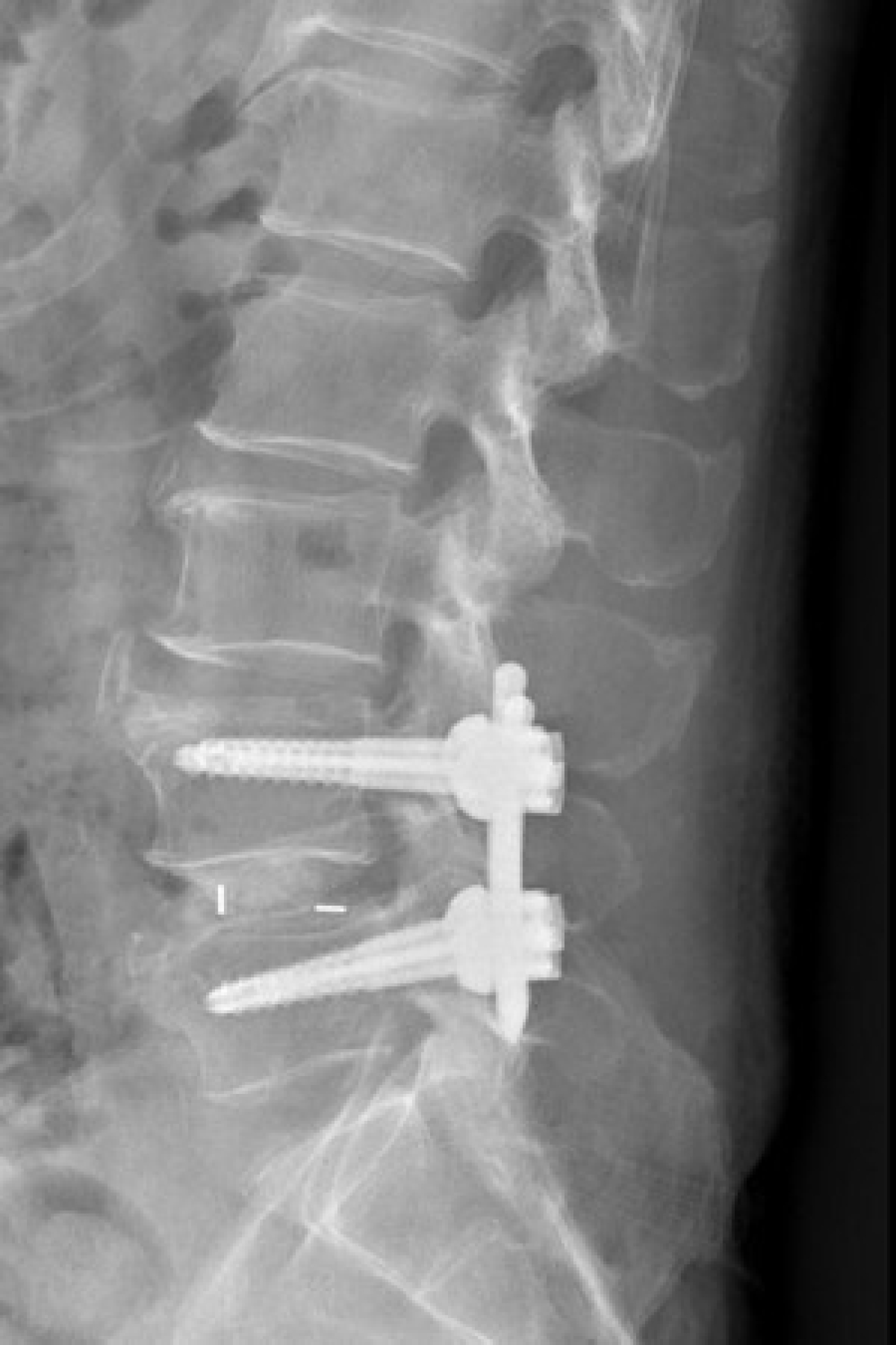 微創手術治療腰椎滑脫　瓦解下背痛讓病人充滿驚喜