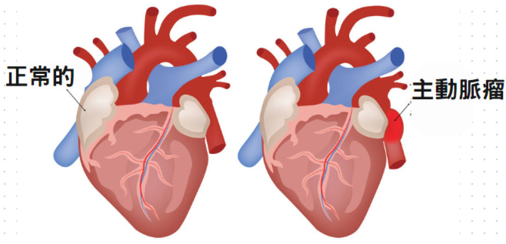 認識主動脈瘤疾病及其治療方式