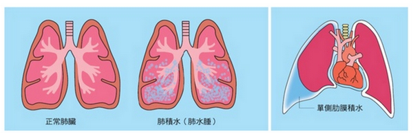 心臟衰竭 心臟衰竭