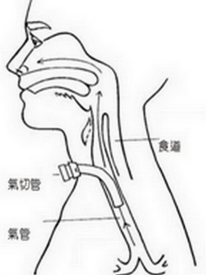 氣切